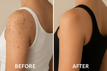 Acne Armor (Body Acne)